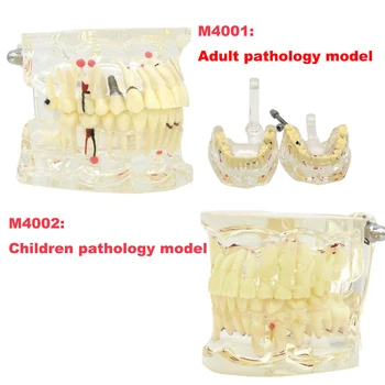 Модель Зубов, заболевание имплантатов, патология для взрослых / детей, демонстрационные модели зубов для обучения практике стоматолога